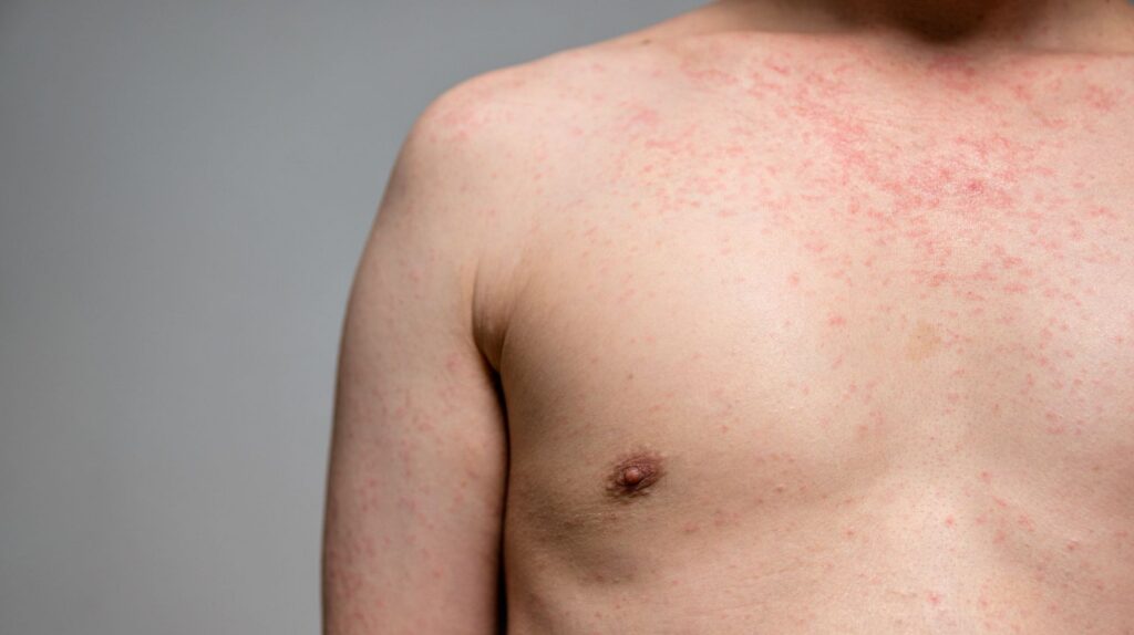 São Paulo tem primeiro caso de sarampo em 2026: entenda o risco