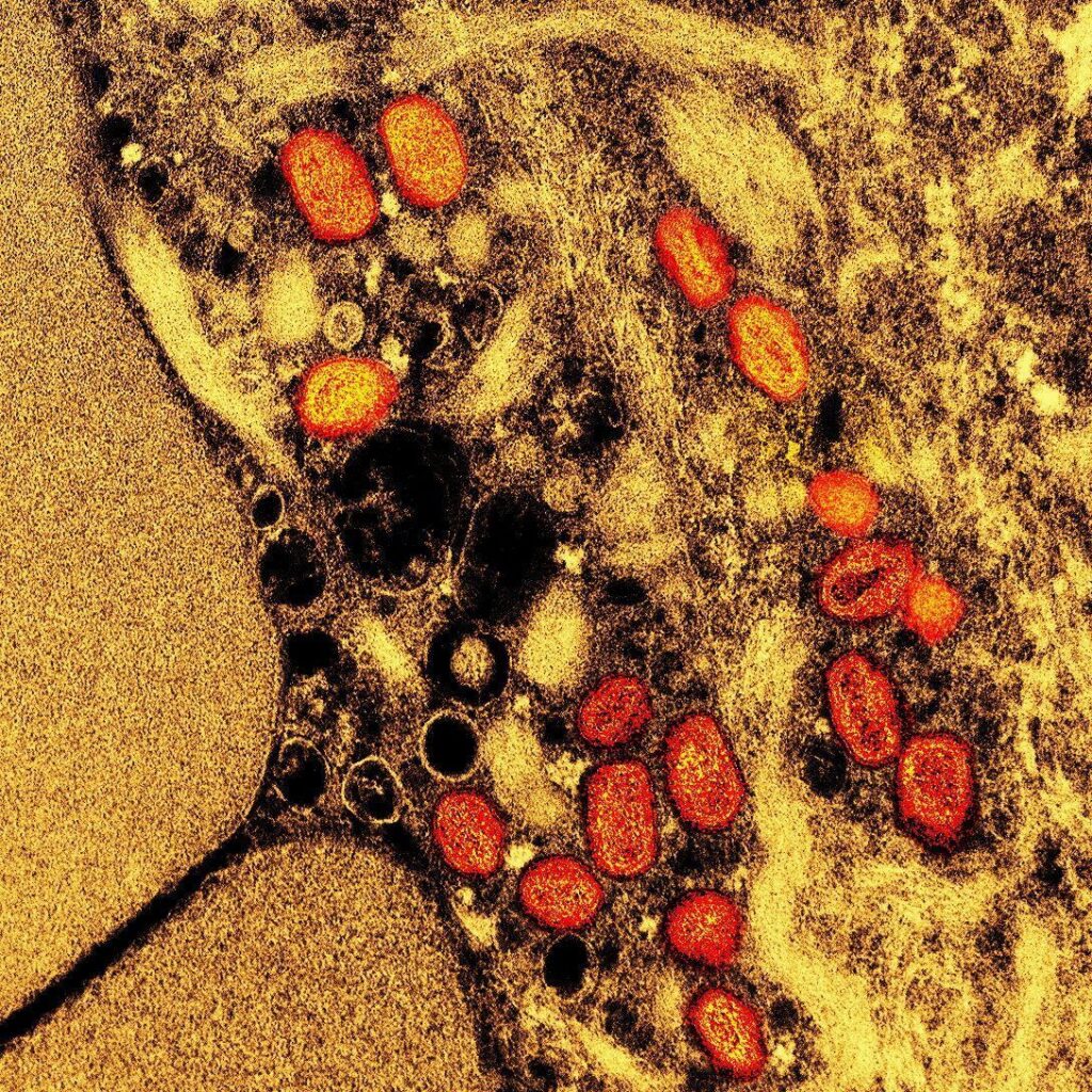 Brasil chega a 140 casos confirmados de mpox em 2026 por estado