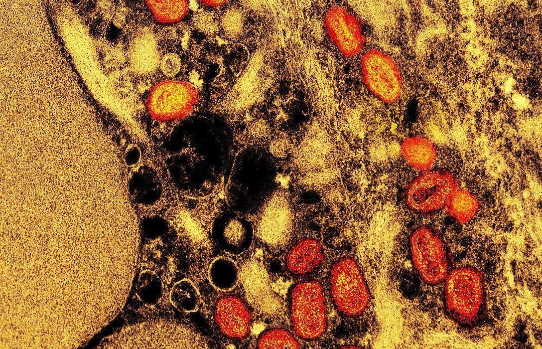 Brasil chega a 140 casos confirmados de mpox em 2026 por estado