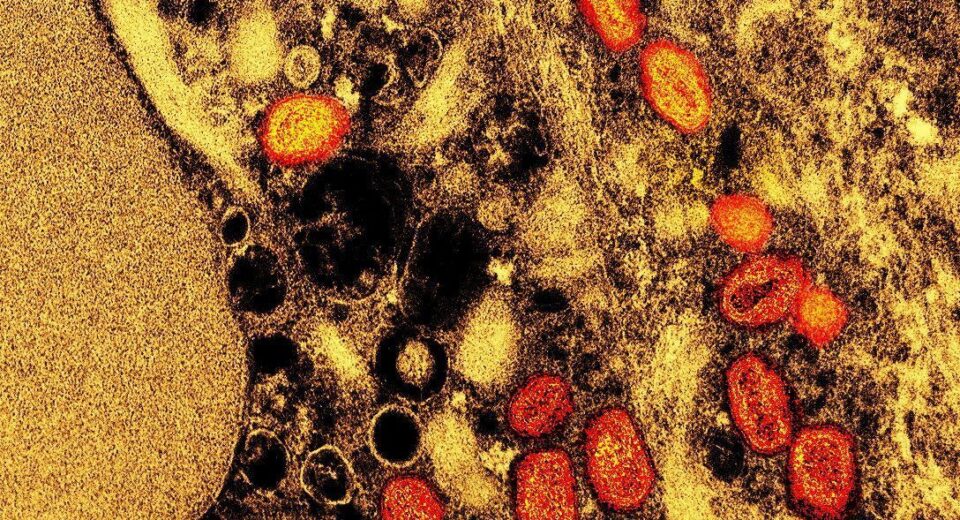 Brasil chega a 140 casos confirmados de mpox em 2026 por estado