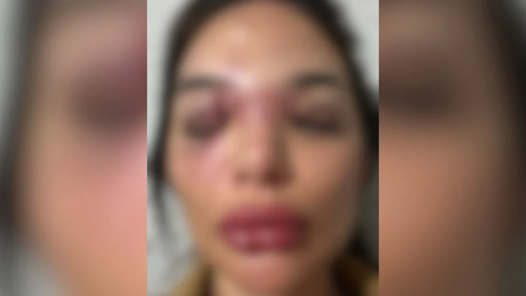 Depoimento de mulher agredida por empresário em São Paulo: Impacto e Superação